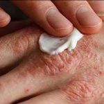 اگزمای بهاری امانتان را بریده؟ راه رهایی اینجاست