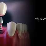 ایمپلنت اشترومن: انتخابی هوشمندانه برای لبخندی ماندگار