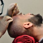 کاشت مو طبیعی با بهترین تکنیک‌ها در لیماکاشت