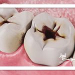 دمنوش‌هایی که دندان را پوسیده می‌کنند