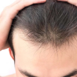رژیم غذایی مناسب بعد از کاشت مو
