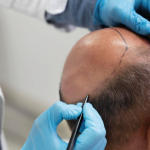 بررسی کامل علل، علائم، پیشگیری و درمان ریزش شوک بعد از کاشت مو چیست؟