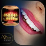 لمینت دندان بهتر است یا کامپوزیت؟