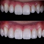 آگهی/ کامپوزیت هیبریدی دندان چیست و چه تفاوتی با سایر کامپوزیت ها دارد؟
