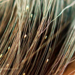 تعریف و معرفی شپش سر (Pediculus humanus capitis)