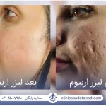 لیزر اربیوم؛ درمان فوری و قطعی جای جوش، حذف تتو و بخیه