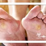 راهکار مقابله با زخم پای دیابتی
