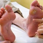دیابتی‌ها چه کار کنند زخم پای دیابتی نگیرند؟