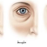 گودی و سیاهی زیر چشم؛ علت و راهکارهای رفع آن