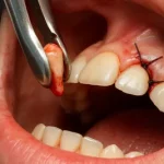 هزینه کشیدن دندان 1404 با جدول قیمت واقعی و نکات مهم