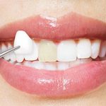 آگهی/ معرفی لمینت دندان و تاثیر آن بر زیبایی لبخن