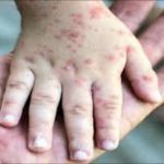عوارض بروز آبله‌مرغان در بزرگسالی