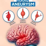 کیم کارداشیان به آنوریسم مغزی مبتلا شده، اما مشکل او چقدر جدی است؟
