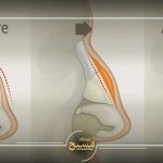 قیمت تیپ پلاستی بینی در تهران؛ بررسی تخصصی و عوامل تأثیرگذار