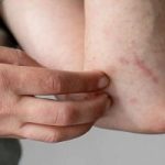 اگر این علائم در پوست شما ظاهر شد یعنی در حال ابتلا به دیابت هستید