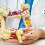 هشدار درباره افزایش این نوع بیماری کشنده در روده ی گروه‌های سنی ۲۰ تا ۳۰ ساله