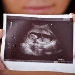 تشخیص زودهنگام «سندرم داون» از روی استخوان بینی!!