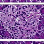 امید تازه برای درمان دیابت نوع ۱ با سیستم ایمنی ترکیبی