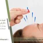 طب سوزنی برای میگرن؛ روشی طبیعی و بی‌عارضه برای کنترل سردردهای میگرنی