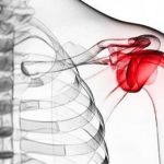 شانه یخ‌زده چیست؟+ علل و روند ایجاد بیماری