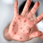 علائم و نشانه‌های آبله‌مرغان و راه های درمان آن