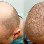 کاشت مو در مشهد | انتخاب آگاهانه برای نتیجه طبیعی و ماندگار