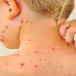 موارد ابتلا به سرخک در جهان افزایش یافت
