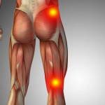 نقش اعصاب سیاتیک در ایجاد پادرد